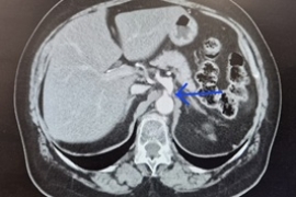 Pierwsza operacja zespołu Dunbara